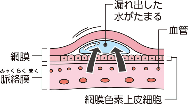 目 に 水 が たまる 治る