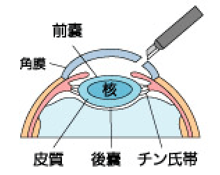 cataract-