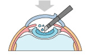 cataract-