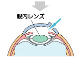 cataract-